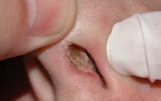 Стафилококк золотистый способы лечения в носу у взрослых