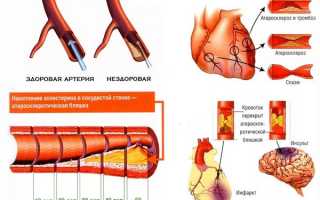 Симптомы и причины ИБС