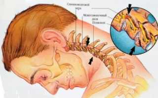 Чем и как лечить шум в ушах при остеохондрозе?
