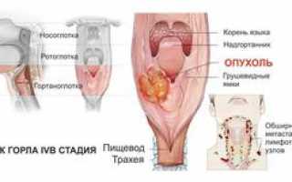 Симптомы и лечение опухоли в горле: признаки рака гортани