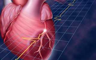 Что такое обширный инфаркт миокарда: шансы выжить, последствия, обзор отзывов пациентов