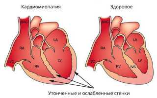 Что такое токсическая кардиомиопатия?