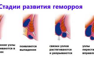 Обзор средств от геморроя: рейтинг лучших и эффективных препаратов