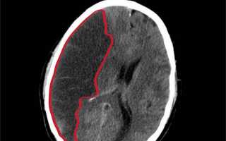 Инфаркт головного мозга: причины и последствия