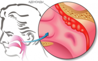 Как лечить аденоиды детям без операции