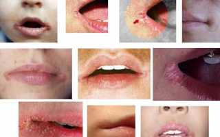 Как лечить болячки на губах?