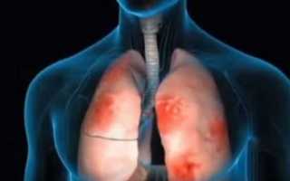 Пневмония: заразна или нет. Виды, возбудители и как передается