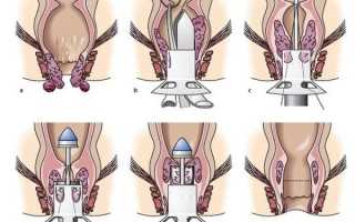 Геморроидэктомия — хирургическое удаление геморроя классическим методом и по методике Лонго