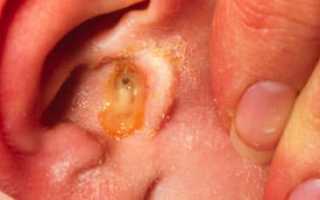 Гной в ухе: симптомы и лечение острого гнойного отита