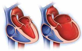 Чем опасна дилатационная кардиомиопатия?