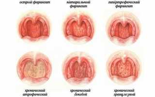 Красная задняя стенка горла: причины и лечение