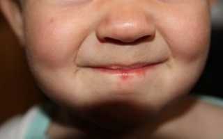 Откуда берется герпес на лице у ребенка и как его лечить?