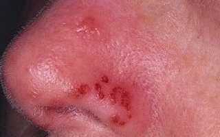 Причины появления и способы лечения герпеса в носу