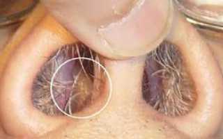 Симптомы и лечение полипов в носу, проведение полипотомии