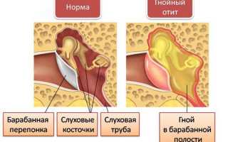 Острый и хронический отит среднего уха: лечение и причины патологии