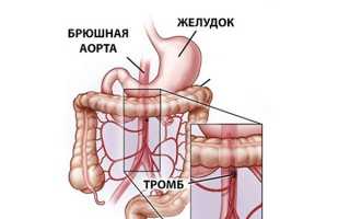 Причины, симптомы и лечение тромбоза мезентериальных сосудов