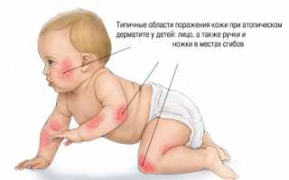 Сыпь на теле у ребенка – возможные причины и опасности