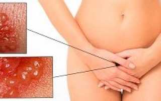Признаки, особенности и лечение генитального герпеса у женщин