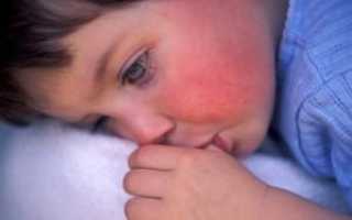 Скарлатина у детей: симптомы и лечение, фото
