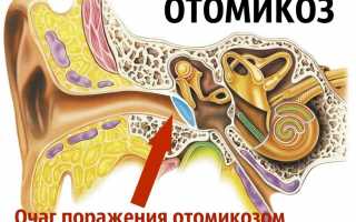 Что такое отомикоз, симптомы и лечение грибкового заболевания ушей