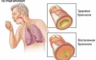 Как избавиться курильщику от кашля: чем лечить курение
