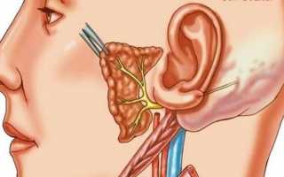 Симптомы и лечение неврита слухового нерва