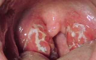 Воспаление миндалин в горле: причины, симптомы и лечение