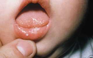 Средство Кандид в лечении полости рта у детей: действие, применение и отзывы