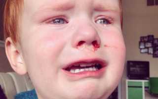 Ребенок ударился носом – первая помощь и возможные осложнения