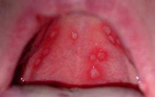 Болячки во рту — возможные причины высыпаний
