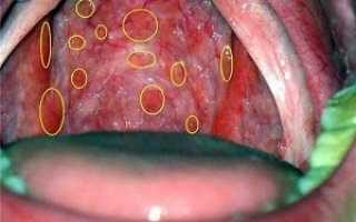 Чем могут быть вызваны волдыри на слизистой горла?