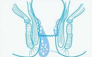 Как выглядит геморрой у мужчин и что делать для лечения в домашних условиях