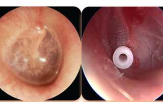 Серозный отит у детей и взрослых: причины, симптомы, лечение