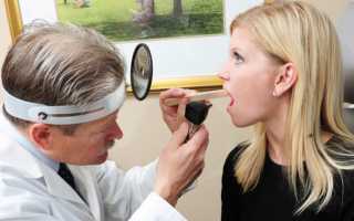 Белое горло — симптом опасных заболеваний