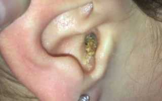 Причины появления серных пробок в ушах