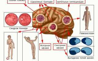Основные симптомы и признаки рака головного мозга