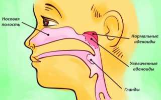 Носоглоточная миндалина: особенности и гипертрофический процесс