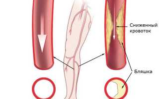 Клинические формы и лечение облитерирующего атеросклероза нижних конечностей