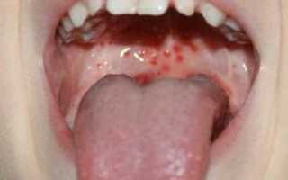 Сыпь в горле — как определить болезнь?
