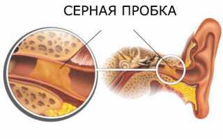 Серные пробки: почему появляются и как избавиться?