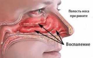 Как восстановить слизистую носа чем увлажнить носоглотку
