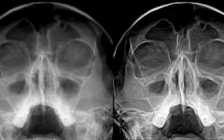 По каким показаниям и как выполняется рентген пазух носа