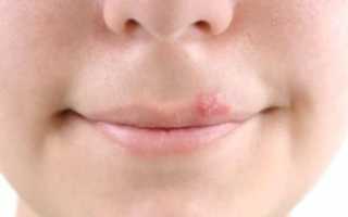 Основные стадии развития герпеса на губах