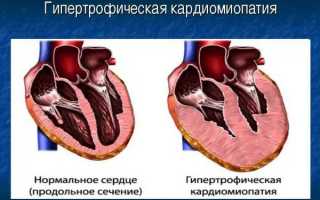 Что такое гипертрофическая кардиомиопатия?