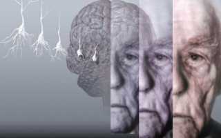 Что такое болезнь Альцгеймера? Как выявить на ранней стадии