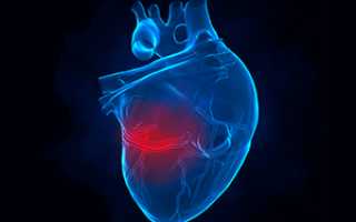 Можно ли определить микроинфаркт по симптомам и каковы его первые признаки?