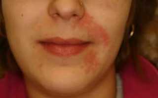 Герпес в носу: симптомы, лечение, мази