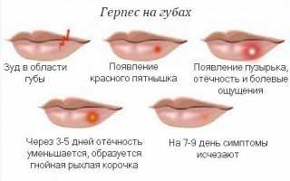 Причины появления герпеса (простуды) на губах