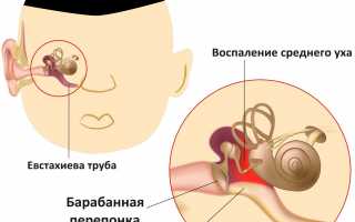 Лечение гнойного отита среднего уха
