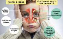 Пазухи носа: особенности строения и функции